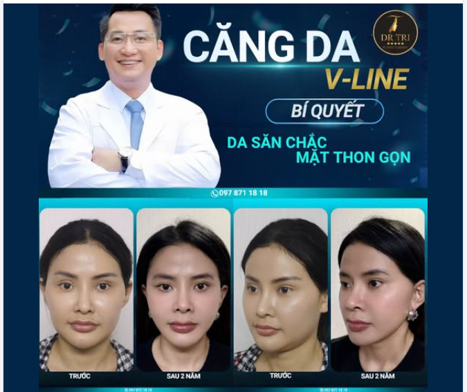 ĐẸP BẤT CHẤP THỜI GIAN VỚI CĂNG DA V-LINE