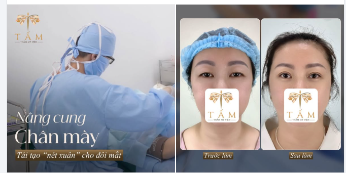 Nâng cung chân mày - Tái tạo nét xuân cho đôi mắt