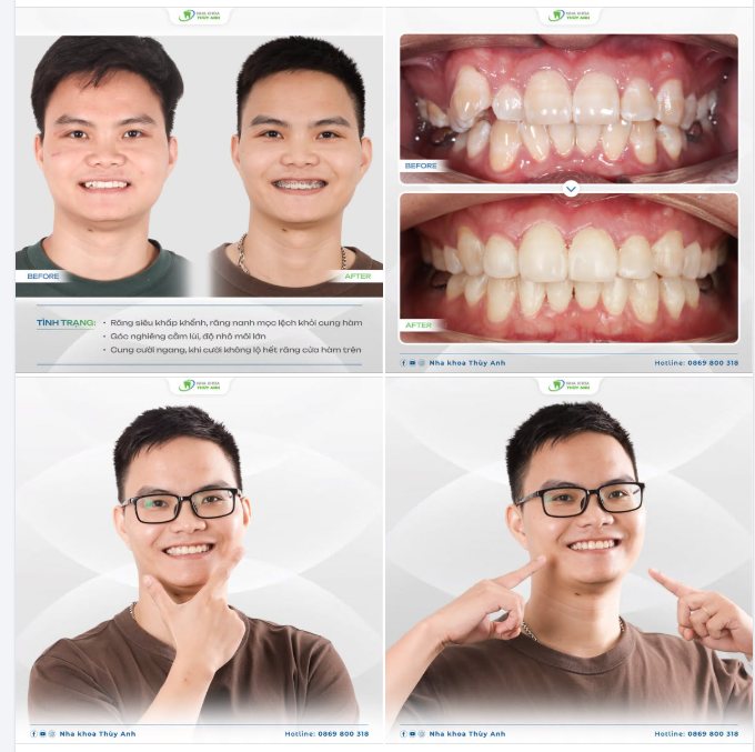 NIỀNG RĂNG ĐỔI NỤ CƯỜI MỚI - NÂNG TẦM TỰ TIN NAM GIỚI HIỆN ĐẠI