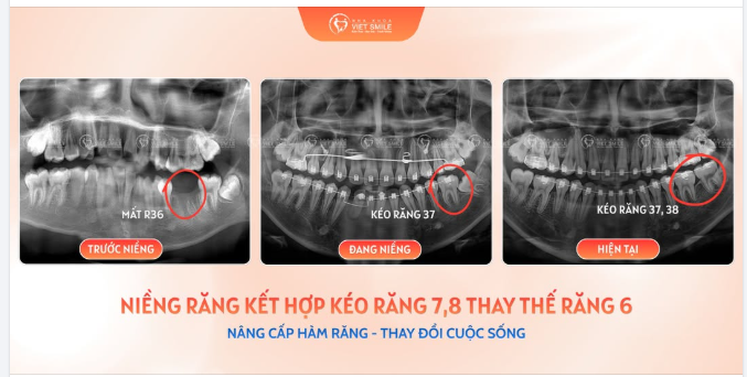 NIỀNG KÉO RĂNG - PHƯƠNG PHÁP PHỤC HỒI RĂNG MẤT KHÔNG XÂM LẤN