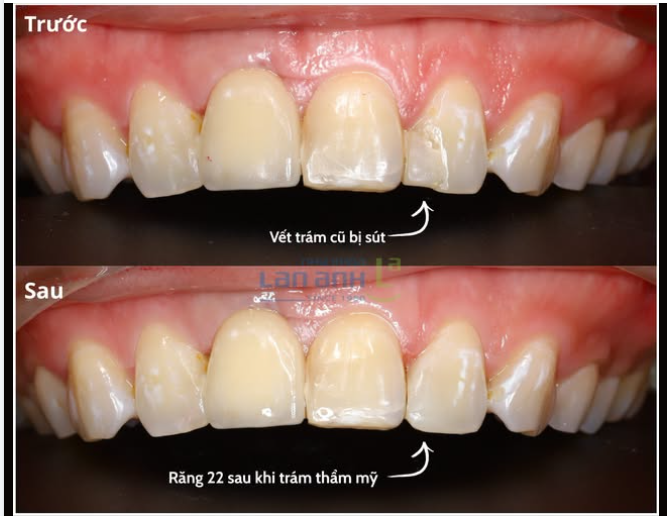 TRÁM THẨM MỸ RĂNG CỬA - NHÌN THÌ DỄ, LÀM MỚI THẤY KHÓ