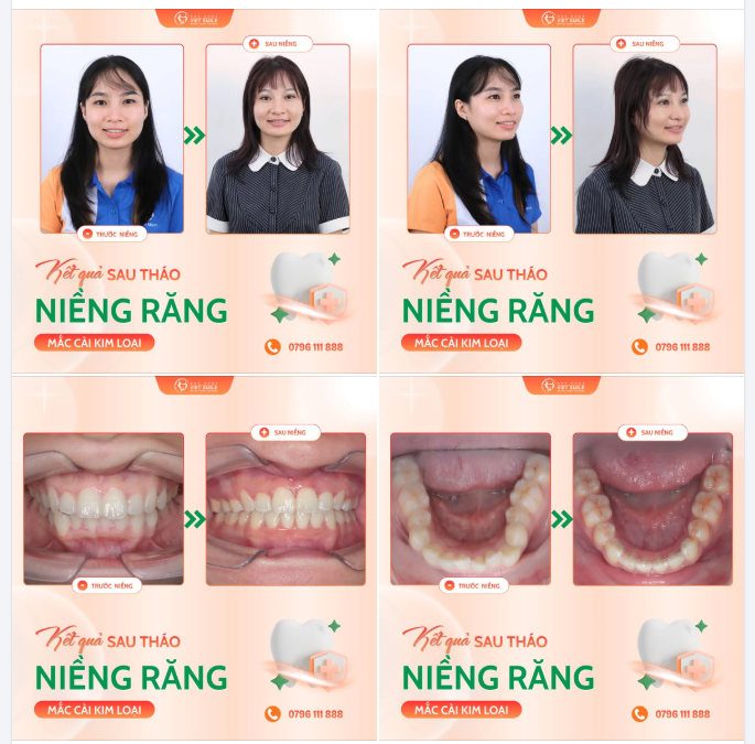 HƠN 2 NĂM NIỀNG RĂNG ĐỔI LẠI NỤ CƯỜI MÀ TRƯỚC ĐÂY CÔ ẤY CHƯA TỪNG DÁM KHOE! 