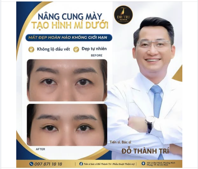 NÂNG CUNG MÀY TẠO HÌNH MÍ DƯỚI: MẮT ĐẸP HOÀN HẢO KHÔNG GIỚI HẠN