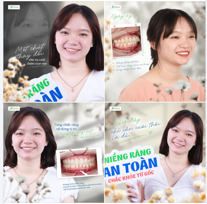 RĂNG CỬA CHEN CHÚC, HÔ CHÌA NHẸ – CHỈNH NHA ĐÃ THAY ĐỔI NỤ CƯỜI CỦA PHẠM KINH OANH NHƯ THẾ NÀO?