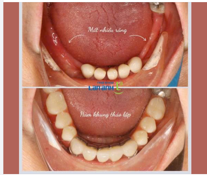 PHỤC HỒI RĂNG MẤT VỚI HÀM THÁO LẮP