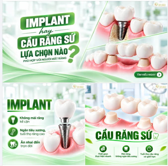 MẤT RĂNG – CHỌN IMPLANT HAY CẦU RĂNG SỨ?
