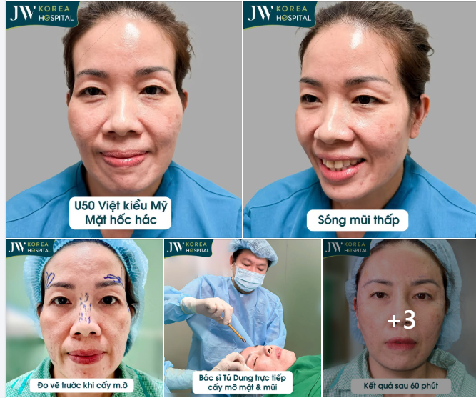 U50 VIỆT KIỀU MỸ ĐƯỢC CHỒNG ĐÍCH THÂN HỘ TỐNG ĐẾN JW TÌM BÁC SĨ TÚ DUNG – MONG MUỐN LẤY LẠI GƯƠNG MẶT TRÒN ĐẦY, PHÚC HẬU SAU NHIỀU NĂM LÃΟ ΗÓA