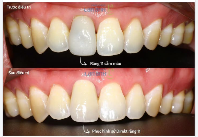 Răng 11: trước hơi “lạc quẻ” về màu sắc.