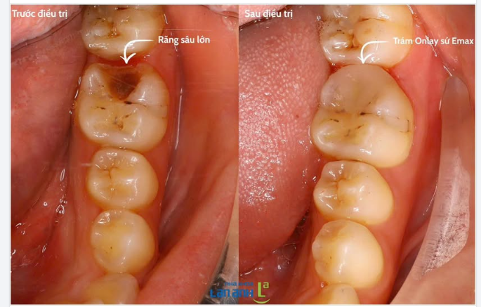 Răng sâu lớn, nhưng chưa chắc phải “bọc cả chiếc răng”