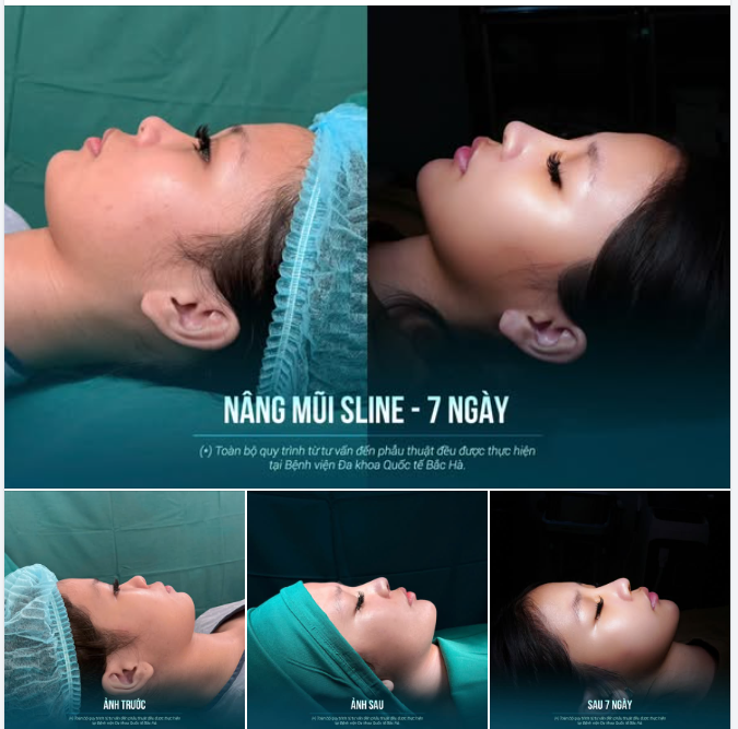 7 NGÀY SAU NÂNG MŨI SLINE – MỘT SỰ THAY ĐỔI VỪA ĐỦ ĐỂ GƯƠNG MẶT HÀI HÒA HƠN