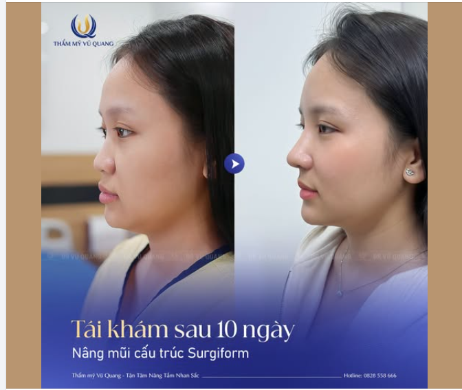 Nếu bạn chưa tin nâng mũi có thể "thăng hạng" nhan sắc?
