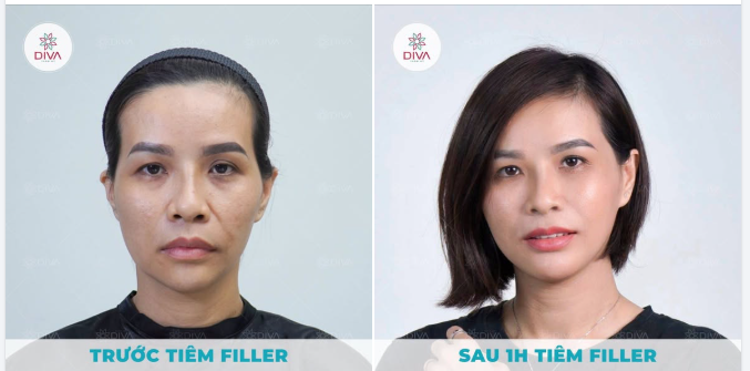 Cải thiện khóe mũi miệng sâu đúng cách như thế nào?
