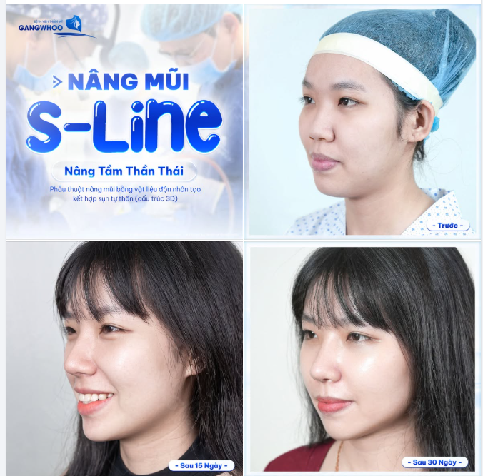 NÂNG MŨI S LINE - NÂNG TẦM THẦN THÁI CHO GƯƠNG MẶT