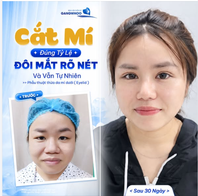 CẮT MÍ ĐÚNG TỶ LỆ - MẮT ĐẸP RÕ NÉT, TỰ NHIÊN