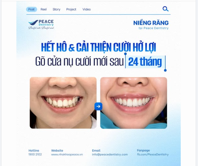CẢI THIỆN TÌNH TRẠNG HÔ CƯỜI HỞ LỢI