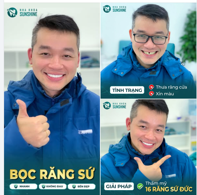 THƯA RĂNG CỬA — TẠI SAO KHÔNG CHỌN BỌC RĂNG SỨ TẠI SUNSHINE?