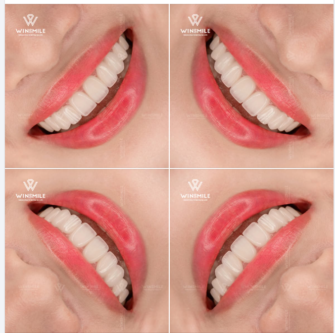 Làm thế nào để thiết kế một nụ cười vừa giữ được sự rạng rỡ tươi trẻ, vừa tôn lên thần thái phóng khoáng và tinh tế của một người phụ nữ U40?