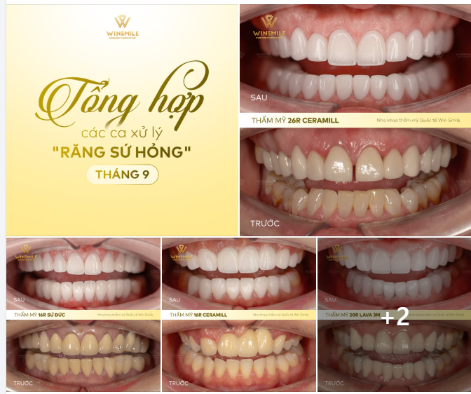 TRAO NIỀM TIN, NHẬN LẠI NỤ CƯỜI NGUYÊN BẢN - TỔNG HỢP NHỮNG CA TÁI SINH NỤ CƯỜI THÁNG 9 TẠI WIN SMILE