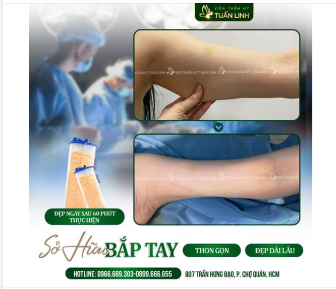 HÚT MỠ BẮP TAY – THON GỌN ĐƯỜNG NÉT, TỰ TIN DIỆN ĐỒ XINH!