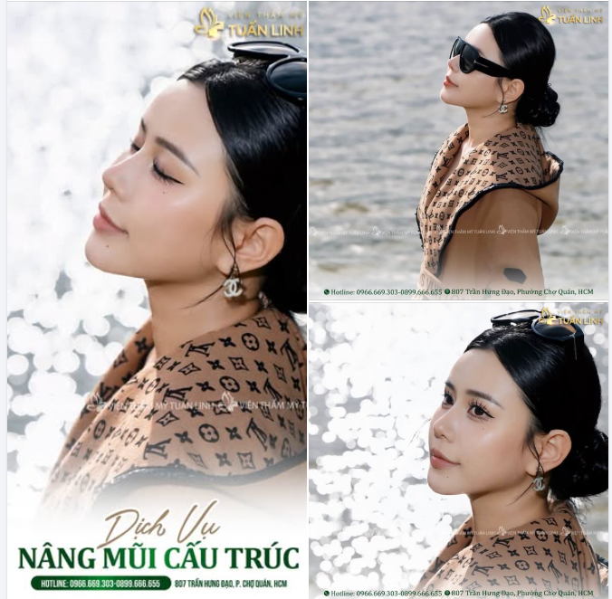 NÂNG MŨI CẤU TRÚC - CHINH PHỤC GÓC NGHIÊNG HOÀN HẢO