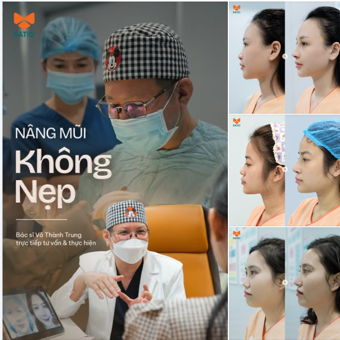 NÂNG MŨI KHÔNG NẸP - TỰ TIN XUẤT HIỆN TRƯỚC ĐÁM ĐÔNG