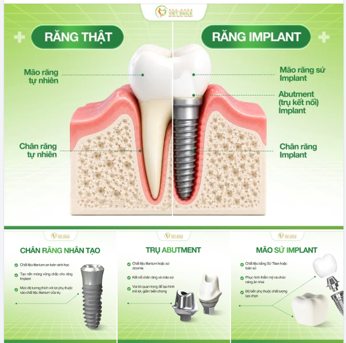 TẠI SAO RĂNG IMPLANT LÀ PHƯƠNG PHÁP HOÀN HẢO THAY THẾ RĂNG THẬT BỊ MẤT?