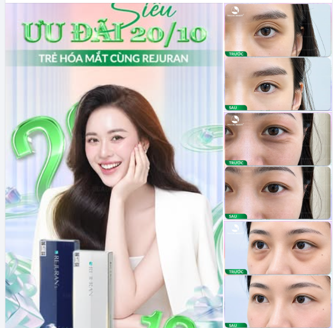 THÁNG CỦA NÀNG – SIÊU ƯU ĐÃI TRẺ HÓA VÙNG MẮT CÙNG REJURAN