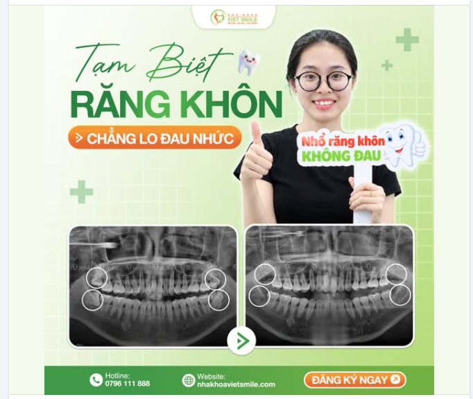 TẠM BIỆT RĂNG KHÔN – CHẲNG LO ĐAU NHỨC!