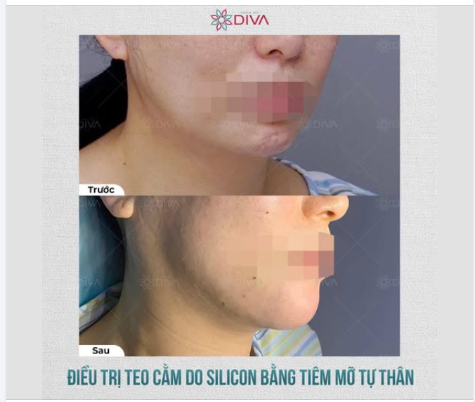 Cải thiện tình trạng rúm ró, teo mô vùng cằm do tiêm Silicon lỗi nhờ phương pháp cấy mỡ