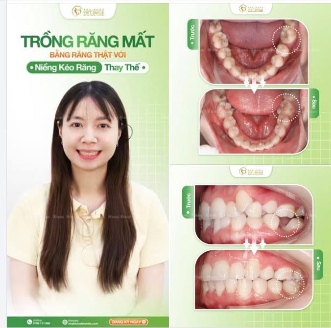 MẤT RĂNG HÀM – KHÔNG NHẤT THIẾT PHẢI TRỒNG IMPLANT!