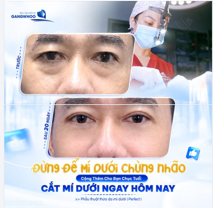 BỌNG MÍ DƯỚI LỘ RÕ, ÁNH NHÌN MỆT MỎI