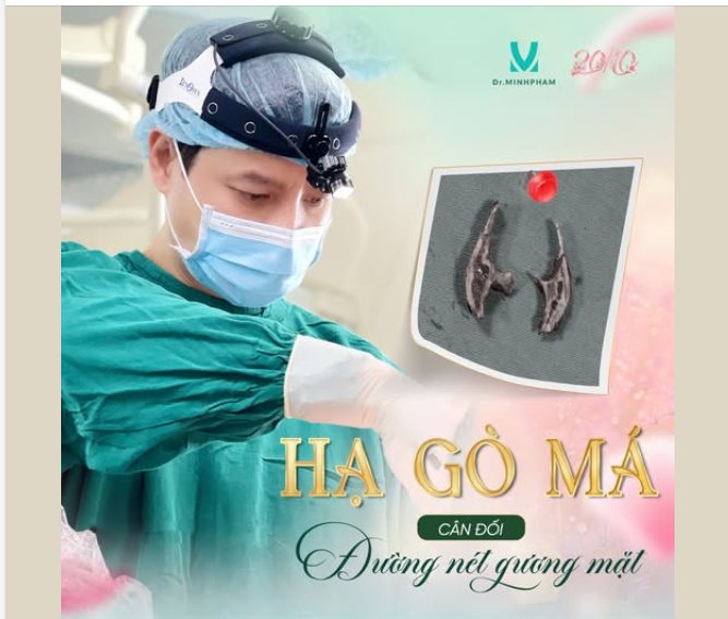 HẠ GÒ MÁ – CÂN ĐỐI ĐƯỜNG NÉT GƯƠNG MẶT