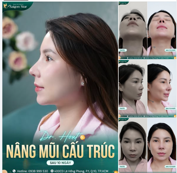 NÂNG MŨI CẤU TRÚC DR. HOẠT KIẾN TẠO MŨI ĐẸP CHUẨN TỈ LỆ VÀNG