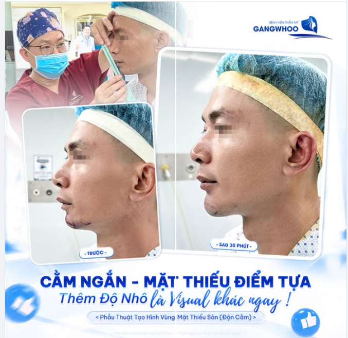 CẰM NGẮN - MẶT THIẾU ĐIỂM NHẤN