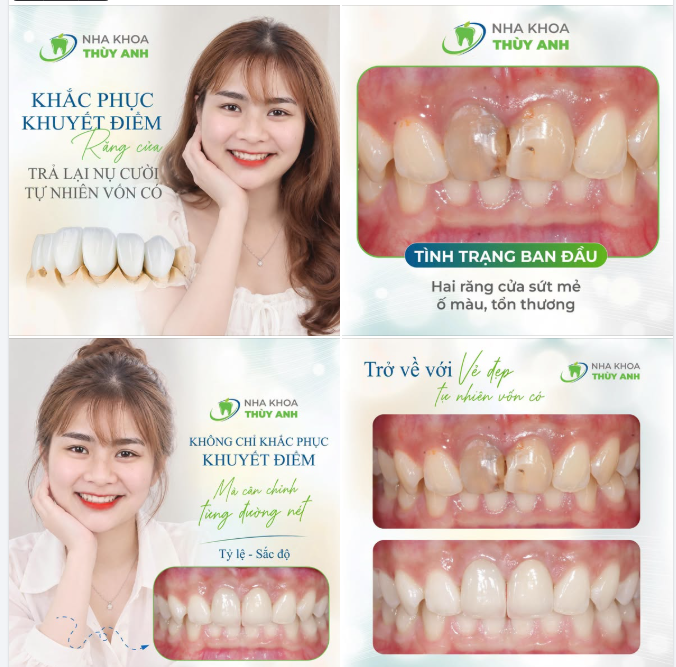 KHẮC PHỤC KHUYẾT ĐIỂM RĂNG CỬA, TRẢ LẠI NỤ CƯỜI TỰ NHIÊN VỐN CÓ