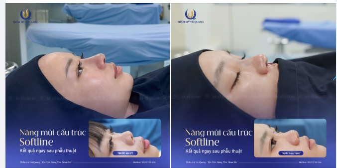 ƯU ĐÃI CỰC SỐC - NÂNG MŨI SOFTLINE CHỈ 28 TRIỆU.