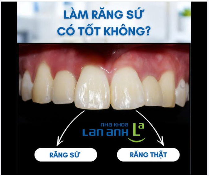 Làm răng sứ có tốt không