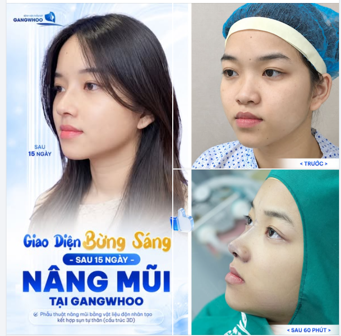 CHỈNH DÁNG MŨI - BẬT THẦN THÁI