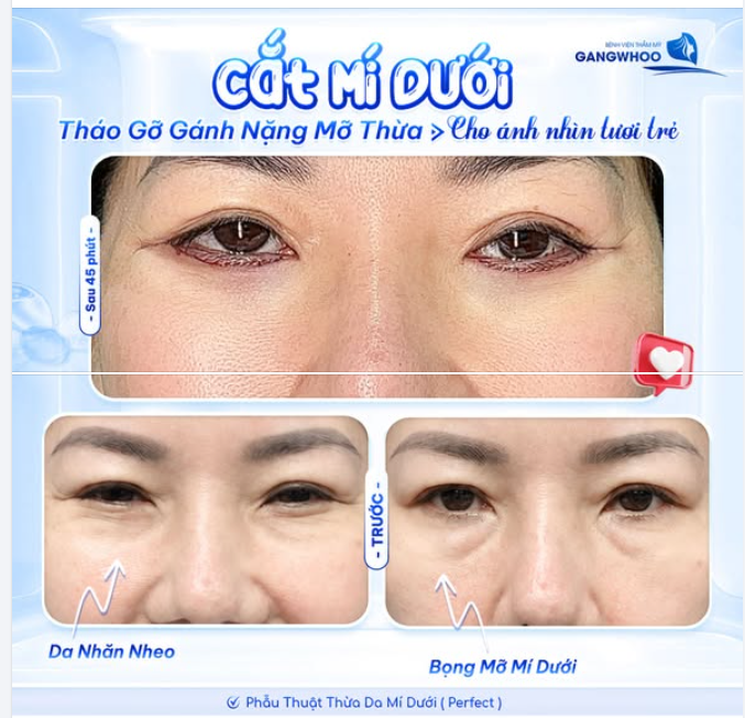 CHỈ 45 PHÚT CẮT MÍ DƯỚI PERFECT