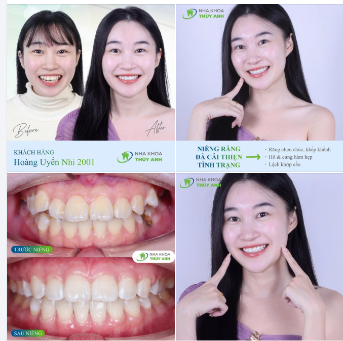 KHI BẠN BẮT ĐẦU TỰ TIN VỚI NỤ CƯỜI CỦA MÌNH