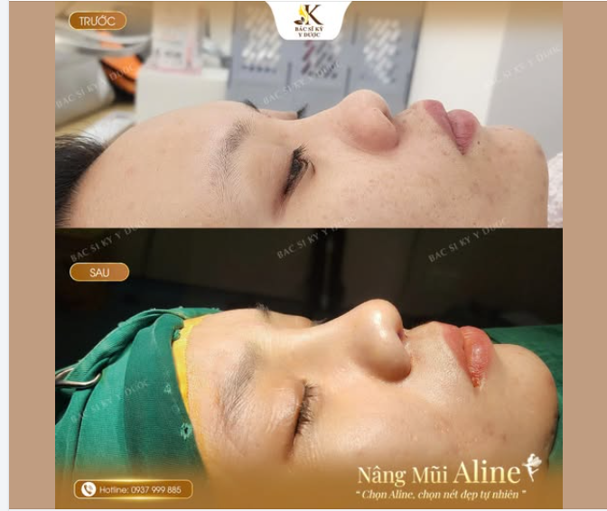 NÂNG MŨI ALINE – THAY ĐỔI GÓC NGHIÊNG, NÂNG TẦM NHAN SẮC
