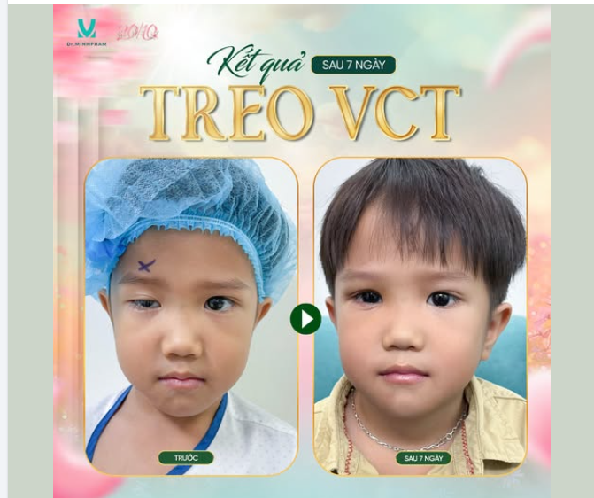 SAU 7 NGÀY TREO MI VCT – ĐÔI MẮT BÉ CÓ SỰ THAY ĐỔI RÕ RỆT