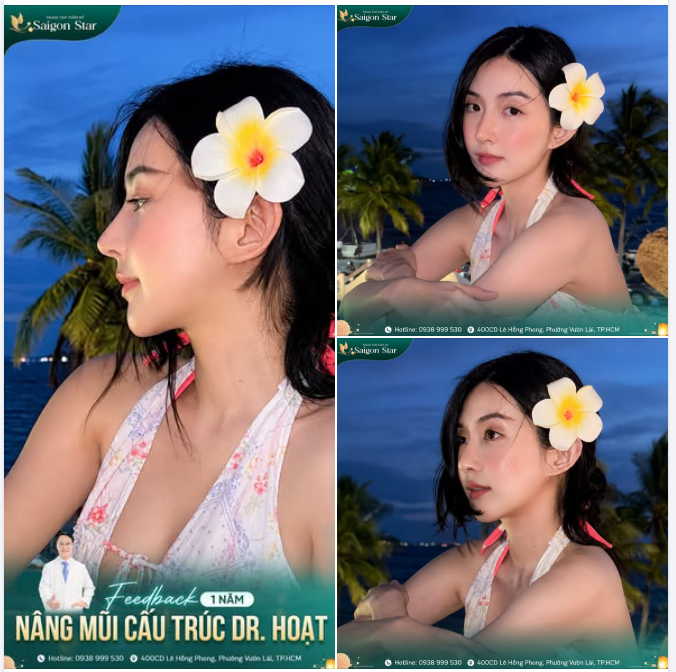 KHÁCH HÀNG SAIGON STAR KHOE NHAN SẮC SÁNG BỪNG SAU 1 NĂM NÂNG MŨI CẤU TRÚC