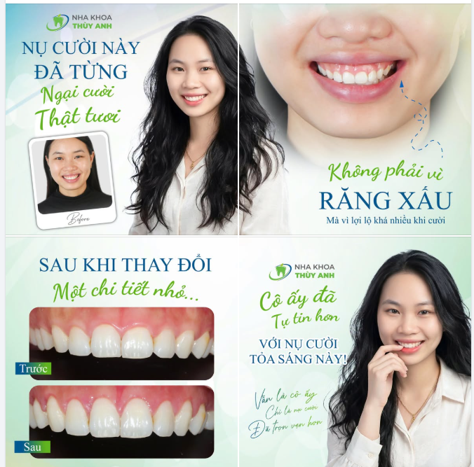 CÓ NHỮNG NỤ CƯỜI, CHỈ CẦN CHỈNH SỬA THÊM MỘT CHÚT LÀ ĐỦ TỰ TIN ĐỂ CƯỜI THẬT TƯƠI