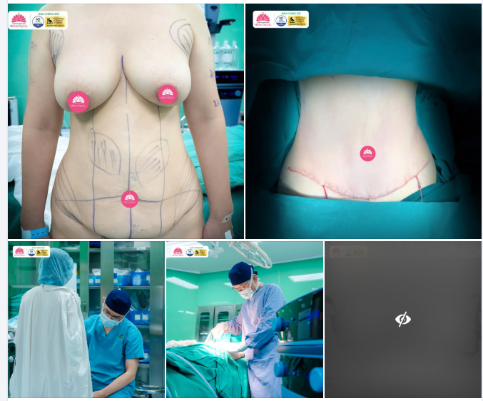 SINH MỔ 3 LẦN, DA BỤNG CHÙNG NHÃO, RẠN NHIỀU - KHÔNG CHỈ HÚT MỠ LÀ ĐỦ