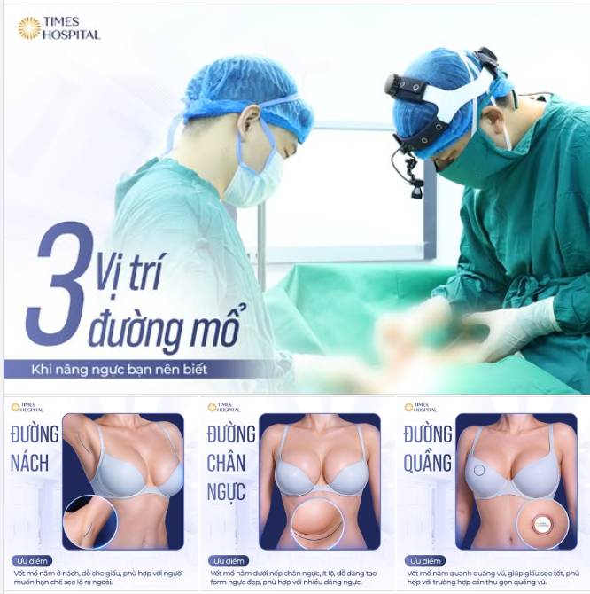 BẬT MÍ 3 ĐƯỜNG MỔ NÂNG NGỰC - HIỂU ĐÚNG ĐỂ CÓ LỰA CHỌN PHÙ HỢP