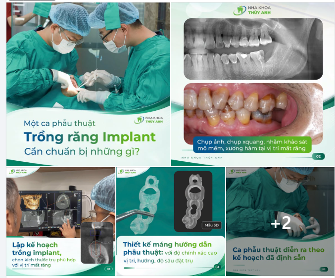 CẦN CHUẨN BỊ NHỮNG GÌ CHO MỘT CA PHẪU THUẬT TRỒNG RĂNG IMPLANT?