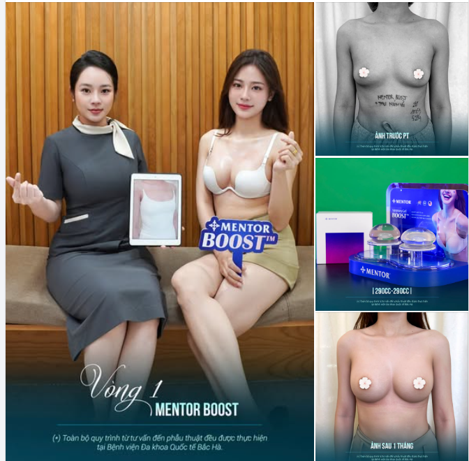 MỘT THÁNG SAU NÂNG NGỰC MENTOR XTRA, KHÁCH HÀNG TRỞ LẠI TÁI KHÁM.