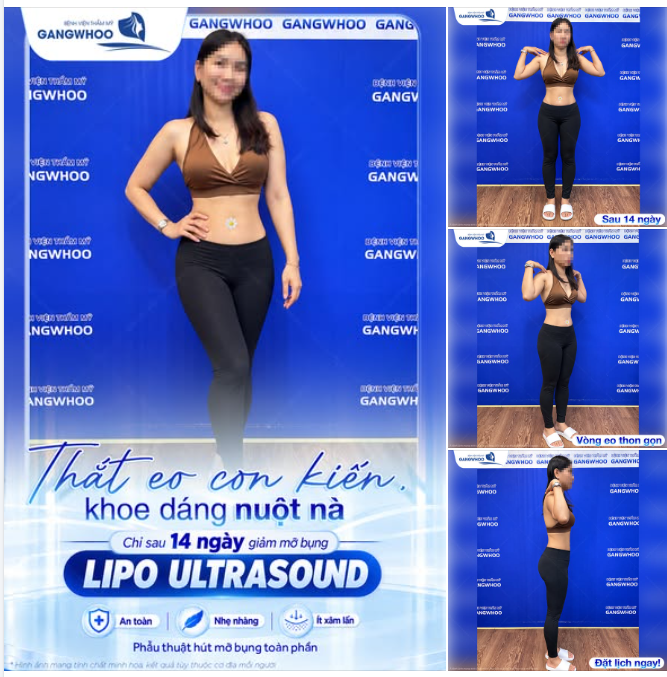 THẮT EO CON KIẾN, KHOE DÁNG NUỘT NÀ - CHỈ SAU 14 NGÀY GIẢM MỠ BỤNG LIPO ULTRASOUND