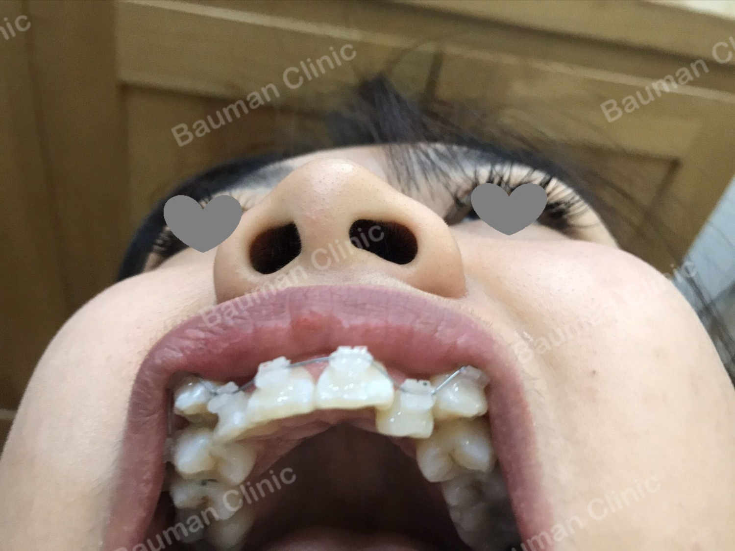 Ca niềng răng số 5088 - Nha khoa Bauman Clinic